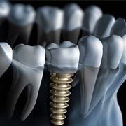 fresno dental implants