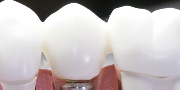 dental implants in fresno