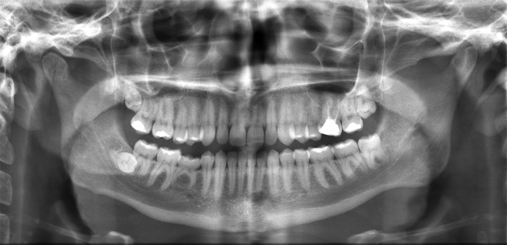 fresno dentist x rays
