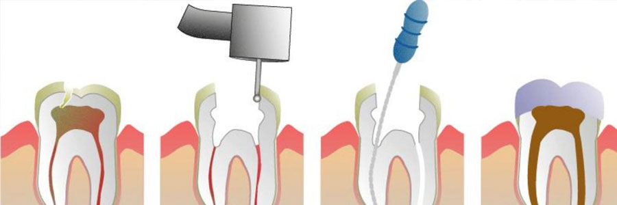 fresno vancouver root canal
