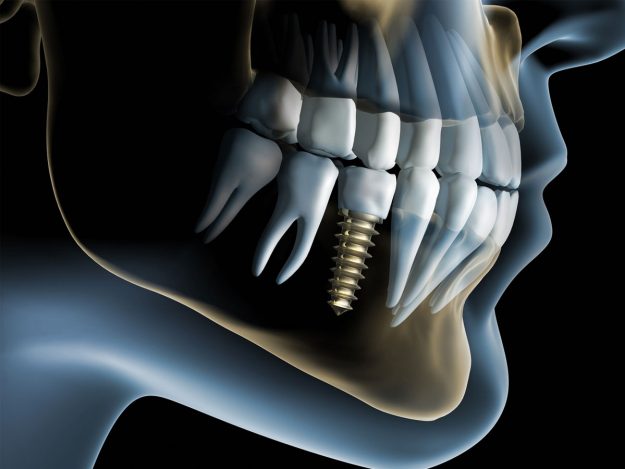 dental implants in fresno