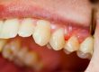gum disease in fresno, ca