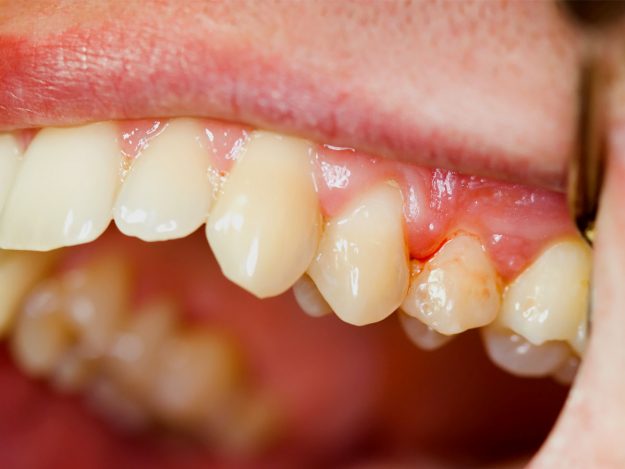 gum disease in fresno, ca