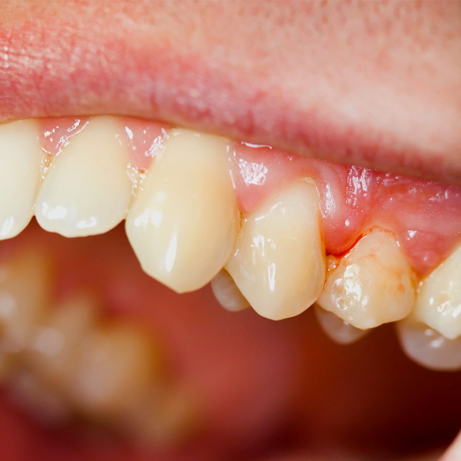 gum disease in fresno, ca