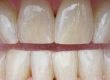 fresno dentist teeth discoloration
