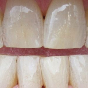 fresno dentist teeth discoloration