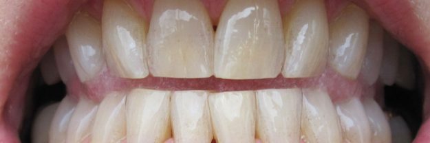 fresno dentist teeth discoloration